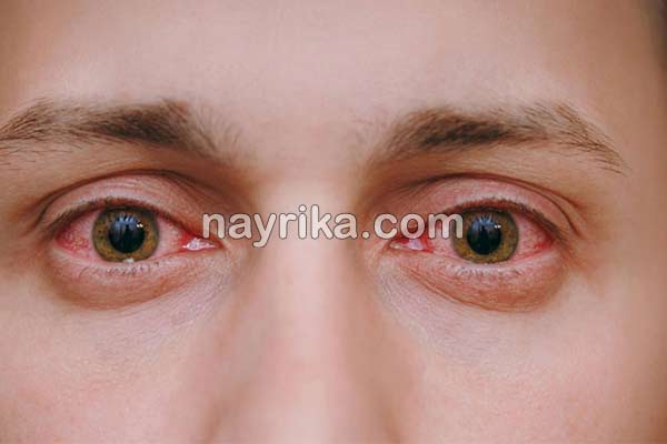 قرمزی چشم, علت قرمزی چشم, علت قرمزی چشم چپ, درمان قرمزی چشم, درمان قرمزی چشم در طب سنتی, قطره برای رفع قرمزی چشم, قرمزی زیر چشم نشانه چیست, درمان فوری قرمزی چشم, درمان سریع خونریزی چشم, رگه های قرمز در سفیدی چشم, اسم قطره برای قرمزی چشم قرمزی چشم, علت قرمزی چشم, علت قرمزی چشم چپ, درمان قرمزی چشم, درمان قرمزی چشم در طب سنتی, قطره برای رفع قرمزی چشم, قرمزی زیر چشم نشانه چیست, درمان فوری قرمزی چشم, درمان سریع خونریزی چشم, رگه های قرمز در سفیدی چشم, اسم قطره برای قرمزی چشم