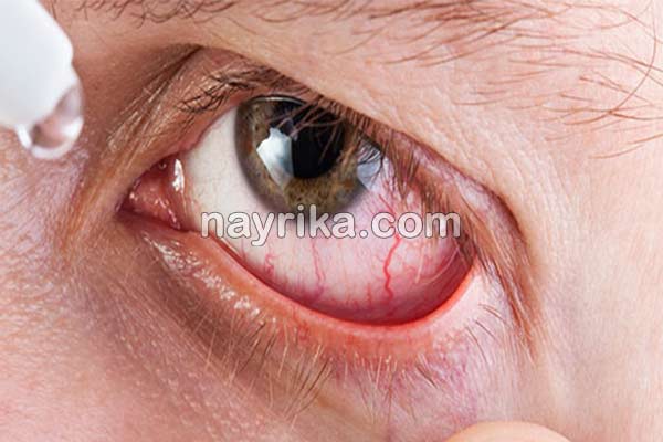 قرمزی چشم, علت قرمزی چشم, علت قرمزی چشم چپ, درمان قرمزی چشم, درمان قرمزی چشم در طب سنتی, قطره برای رفع قرمزی چشم, قرمزی زیر چشم نشانه چیست, درمان فوری قرمزی چشم, درمان سریع خونریزی چشم, رگه های قرمز در سفیدی چشم, اسم قطره برای قرمزی چشم قرمزی چشم, علت قرمزی چشم, علت قرمزی چشم چپ, درمان قرمزی چشم, درمان قرمزی چشم در طب سنتی, قطره برای رفع قرمزی چشم, قرمزی زیر چشم نشانه چیست, درمان فوری قرمزی چشم, درمان سریع خونریزی چشم, رگه های قرمز در سفیدی چشم, اسم قطره برای قرمزی چشم