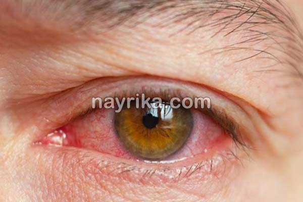 قرمزی چشم, علت قرمزی چشم, علت قرمزی چشم چپ, درمان قرمزی چشم, درمان قرمزی چشم در طب سنتی, قطره برای رفع قرمزی چشم, قرمزی زیر چشم نشانه چیست, درمان فوری قرمزی چشم, درمان سریع خونریزی چشم, رگه های قرمز در سفیدی چشم, اسم قطره برای قرمزی چشم قرمزی چشم, علت قرمزی چشم, علت قرمزی چشم چپ, درمان قرمزی چشم, درمان قرمزی چشم در طب سنتی, قطره برای رفع قرمزی چشم, قرمزی زیر چشم نشانه چیست, درمان فوری قرمزی چشم, درمان سریع خونریزی چشم, رگه های قرمز در سفیدی چشم, اسم قطره برای قرمزی چشم