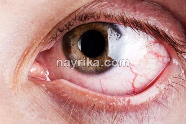 قرمزی چشم, علت قرمزی چشم, علت قرمزی چشم چپ, درمان قرمزی چشم, درمان قرمزی چشم در طب سنتی, قطره برای رفع قرمزی چشم, قرمزی زیر چشم نشانه چیست, درمان فوری قرمزی چشم, درمان سریع خونریزی چشم, رگه های قرمز در سفیدی چشم, اسم قطره برای قرمزی چشم قرمزی چشم, علت قرمزی چشم, علت قرمزی چشم چپ, درمان قرمزی چشم, درمان قرمزی چشم در طب سنتی, قطره برای رفع قرمزی چشم, قرمزی زیر چشم نشانه چیست, درمان فوری قرمزی چشم, درمان سریع خونریزی چشم, رگه های قرمز در سفیدی چشم, اسم قطره برای قرمزی چشم