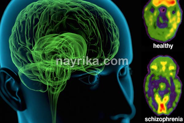 شیزوفرنی, شیزوفرنی چیست, علائم شیزوفرنی, درمان شیزوفرنی, درمان قطعی شیزوفرنی, درمان شیزوفرنی در طب سنتی, تفاوت شیزوفرنی و اسکیزوفرنی, شیزوفرنی خفیف, شیزوفرنی و ازدواج, تست تشخیص شیزوفرنی, شیزوفرنی چیست و درمان شیزوفرنی, شیزوفرنی چیست, علائم شیزوفرنی, درمان شیزوفرنی, درمان قطعی شیزوفرنی, درمان شیزوفرنی در طب سنتی, تفاوت شیزوفرنی و اسکیزوفرنی, شیزوفرنی خفیف, شیزوفرنی و ازدواج, تست تشخیص شیزوفرنی, شیزوفرنی چیست و درمان