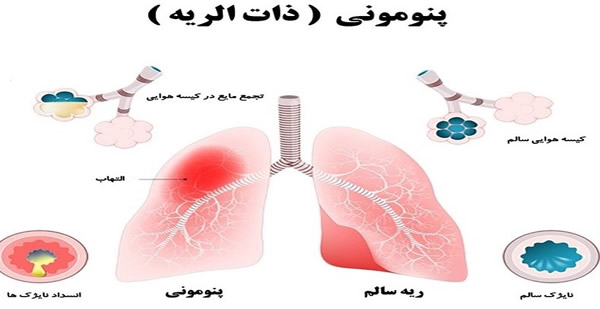 پنومونی: علائم، شیوع و واگیری / پنومونی در چین و ایران / آخرین اخبار پنومونی: علائم، شیوع و واگیری / پنومونی در چین و ایران / آخرین اخبار